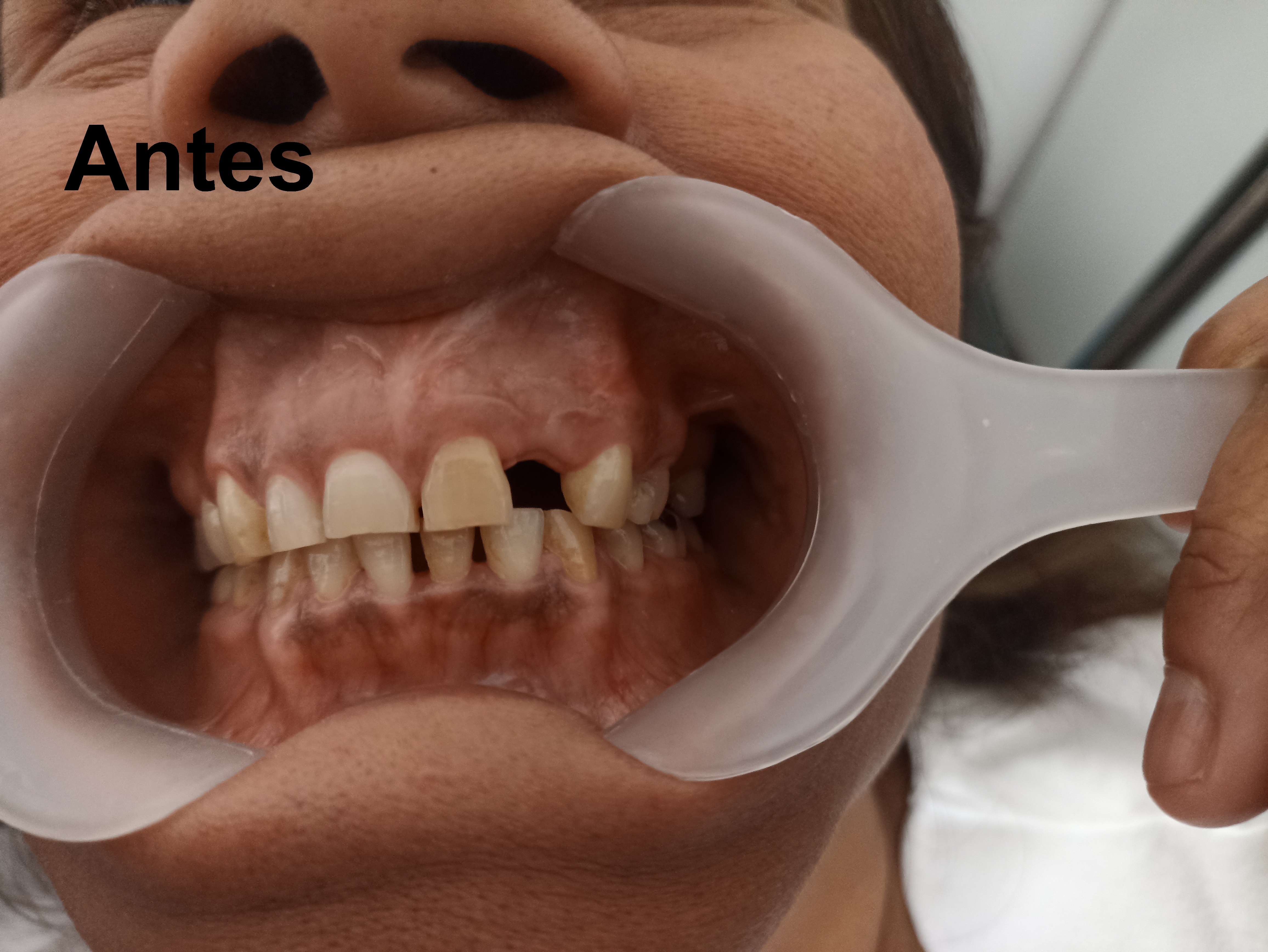 Antes del tratamiento