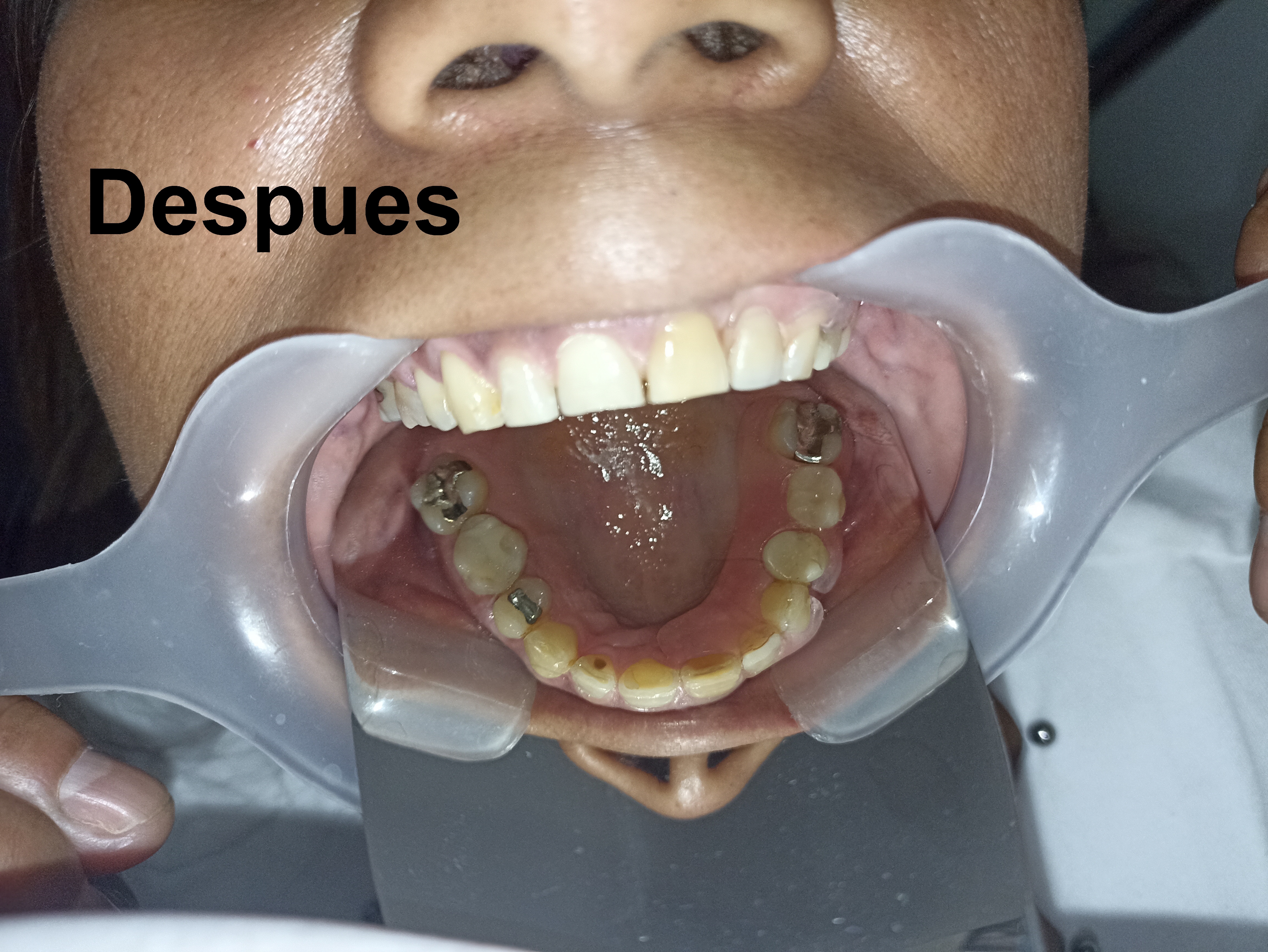 Después del tratamiento