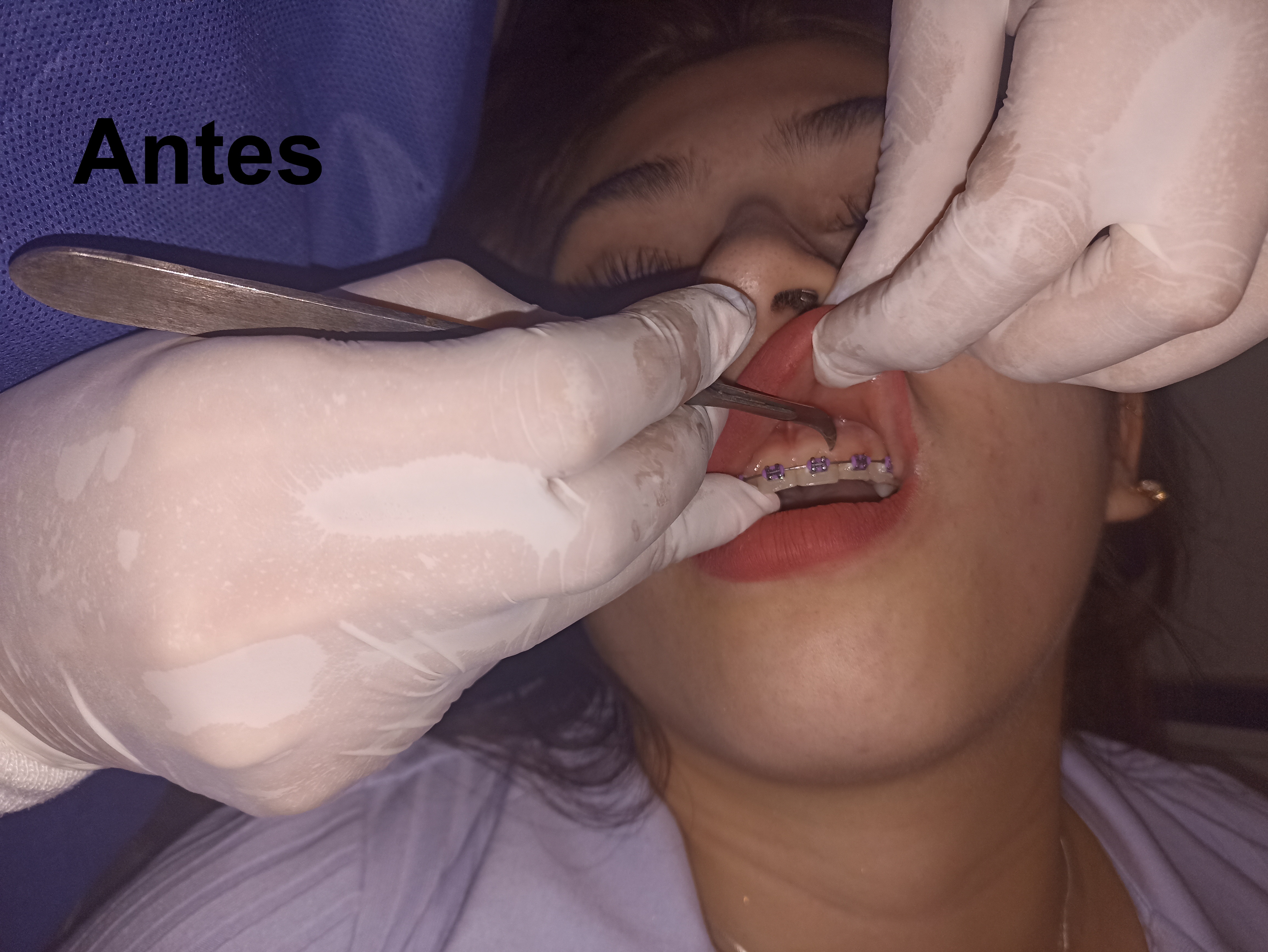 Antes del tratamiento