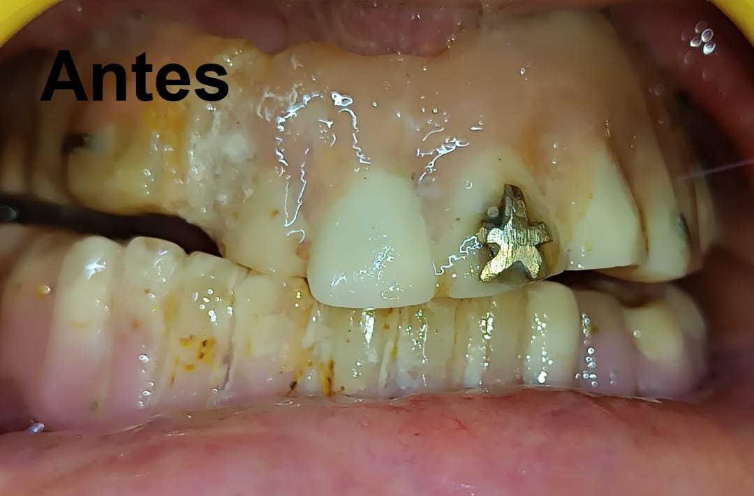 Antes del tratamiento