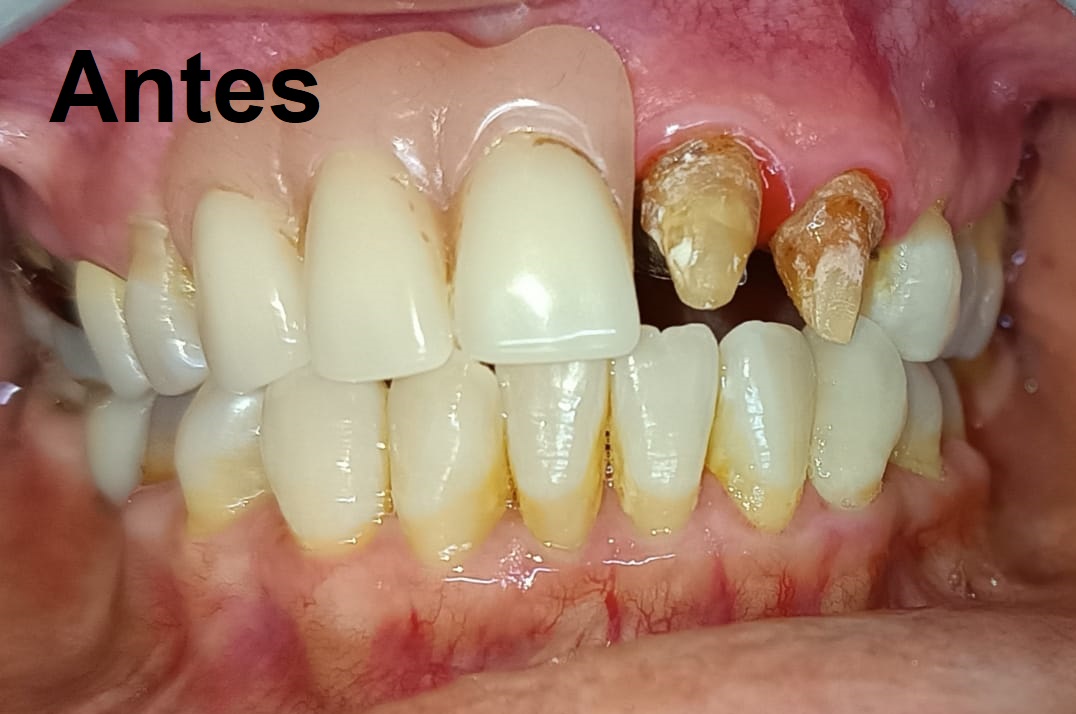 Antes del tratamiento