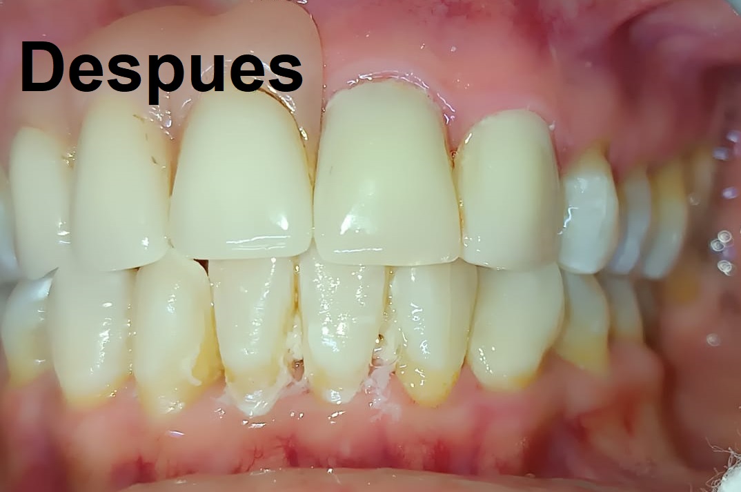 Después del tratamiento