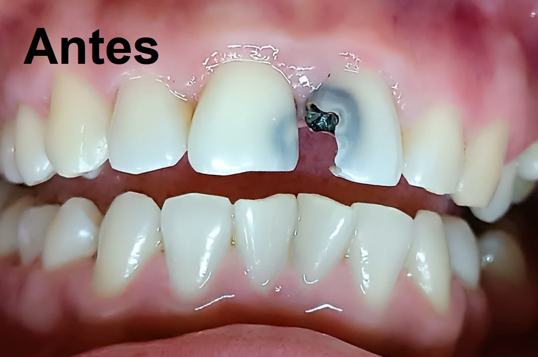 Antes del tratamiento