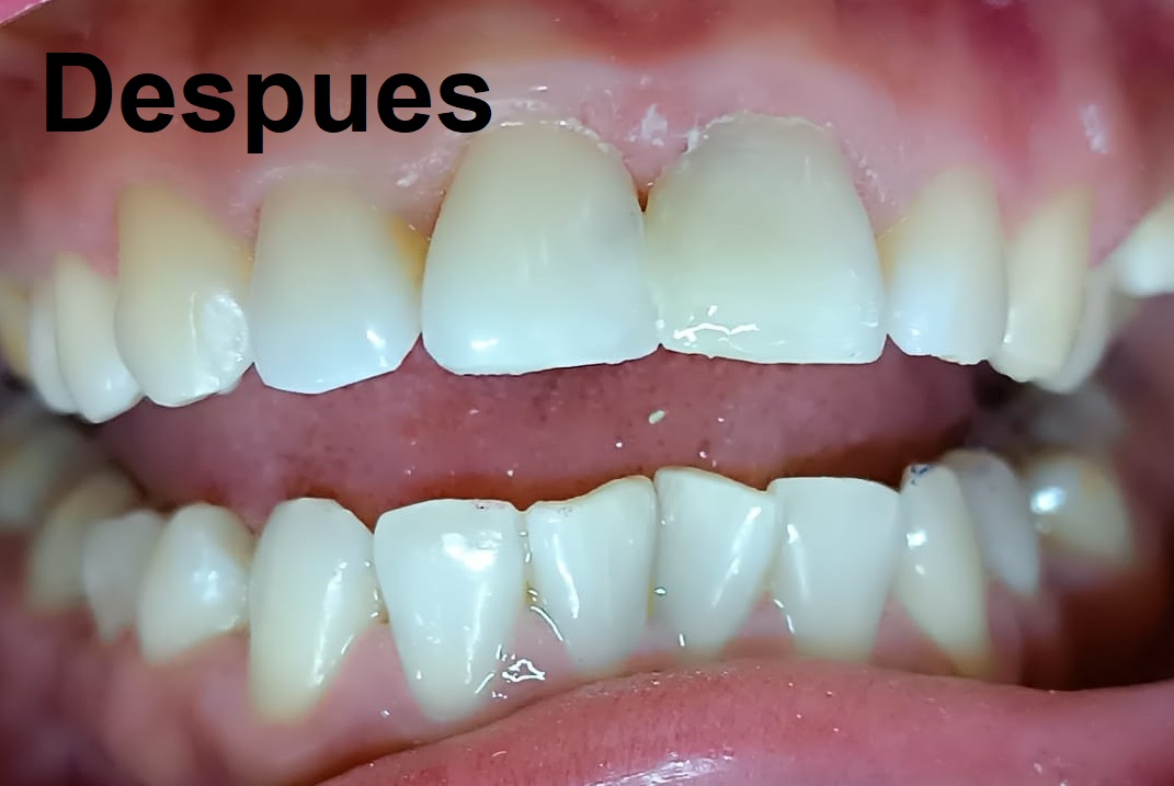 Después del tratamiento