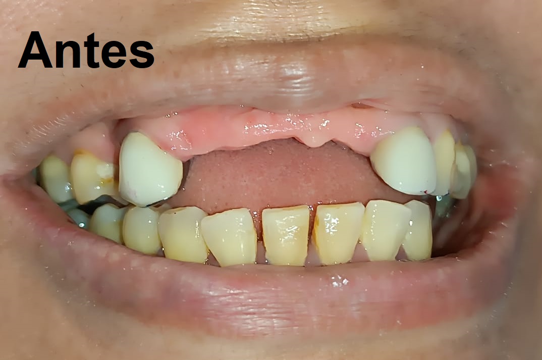 Antes del tratamiento