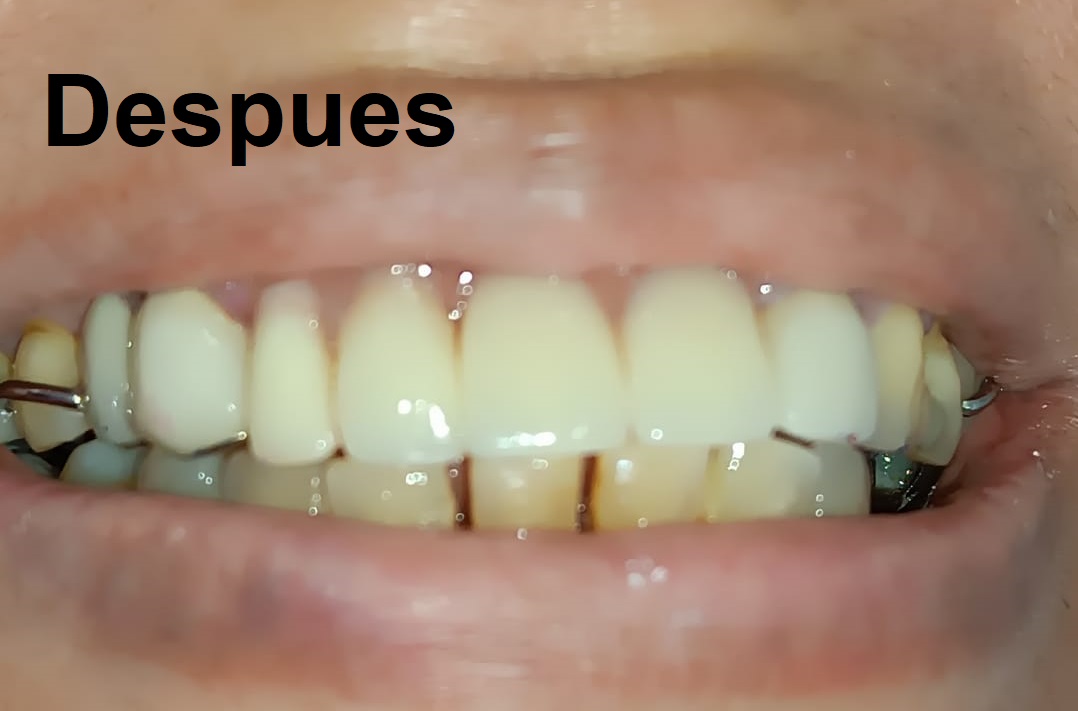 Después del tratamiento
