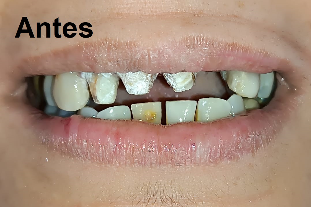 Antes del tratamiento