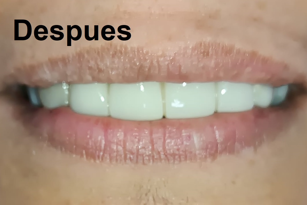 Después del tratamiento