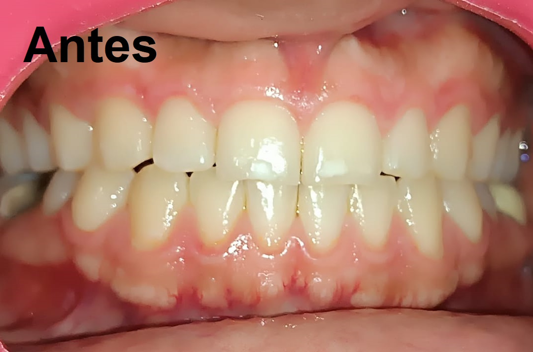 Antes del tratamiento