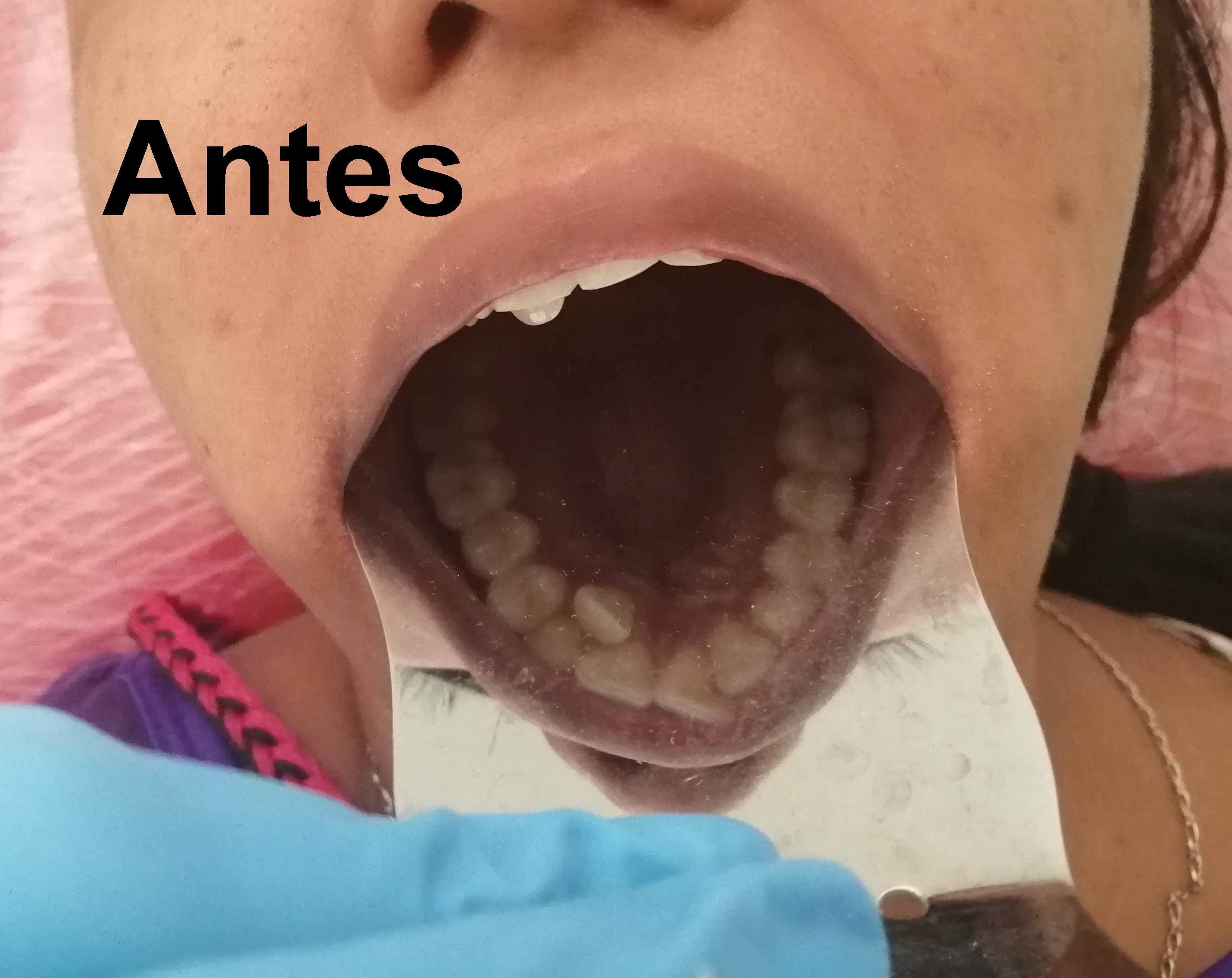 Antes del tratamiento